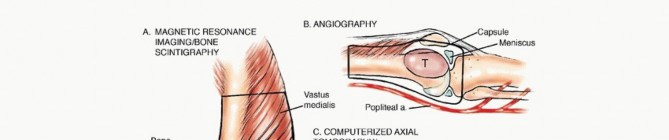 Illustration 11 for Advanced Distal Femoral Resections: Limb-Sparing Outcomes & Techniques