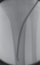 Illustration 18 for Pediatric Tibial Fractures: Avoid Mistakes, Ensure Optimal Healing