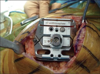 Illustration 12 for Minimal Incision Total Knee: Experience Faster Healing