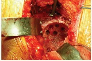 Illustration 15 for Cemented Acetabular Component: Achieving Optimal THA Stability