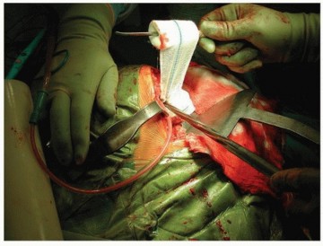 Illustration 25 for Why Polished Tapered Cemented Stems Excel in Hip Replacement