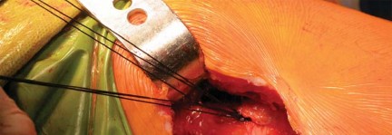 Illustration 58 for Kinectiv® Stem: Modular Necks for Primary THA Success