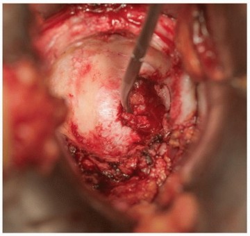 Illustration 4 for Mastering The Uncemented Socket: Ensure Lasting Hip Fixation