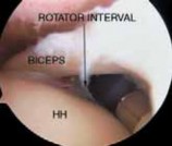 Illustration 9 for Capsular Releases for Loss of Motion: Restore Your Shoulder