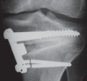 Illustration 48 for Guide Pin Assembly: Key to Flawless Upper Tibial Osteotomy