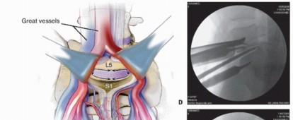 Illustration 7 for Anterior Lumbar Interbody: Fusion, Disc Replacement & Pain Relief