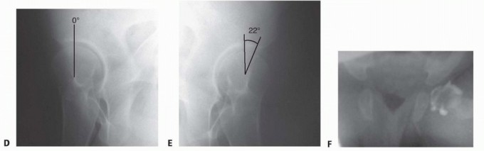 Illustration 7 for Mastering Anterior Open Reduction for Developmentally Dislocated Hip
