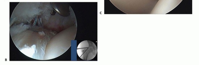 Illustration 29 for Hip Arthroscopy: Your Minimally Invasive Solution for Hip Pain