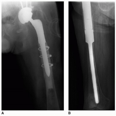 Illustration 36 for Allograft Prosthetic Composite: Mastering Proximal Femur Reconstruction