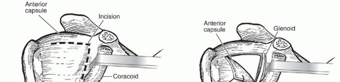 Illustration 15 for Latarjet for Instability: Bone Loss Solutions, Per Burkhart SS, Lo