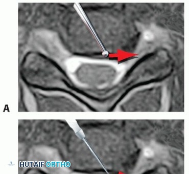Illustration 14 for How ACDF Clears Your Posterior Disc Space for Lasting Relief