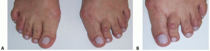 Illustration 3 for Plantar Plate Repair: End Lesser Toe Pain & Instability