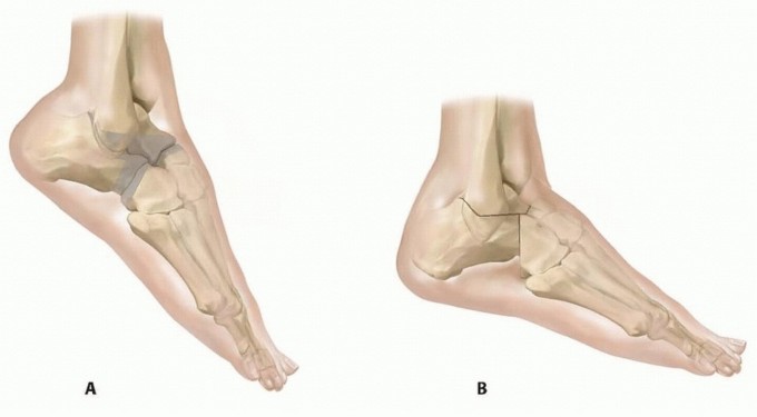 Illustration 7 for Expert Guide to Triple Arthrodesis et al. for Hindfoot