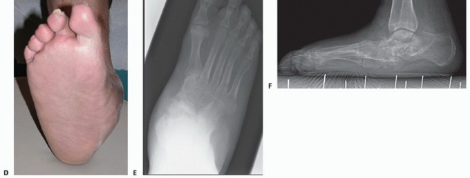 Illustration 11 for Regain Mobility: Surgical Solutions for Charcot Foot Arthropathy