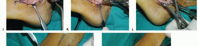 Isolated Subtalar Arthrodesis: When & Why It's Preferred