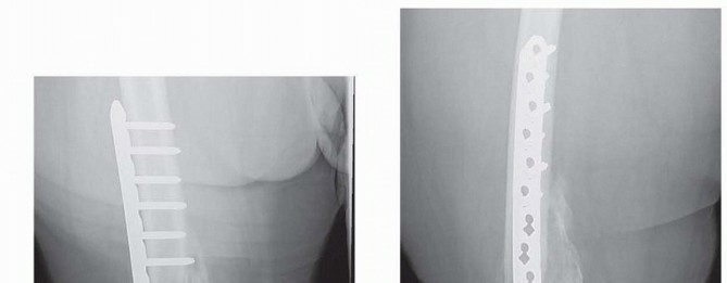Illustration 28 for Repairing Distal Femur Fractures: Open Reduction & Internal Fixation