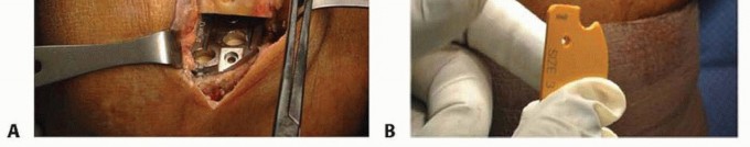صورة طبية: استبدال مفصل الركبة الجزئي: حل متقدم لآلام الركبة المستمرة مع الأستاذ الدكتور محمد هطيف