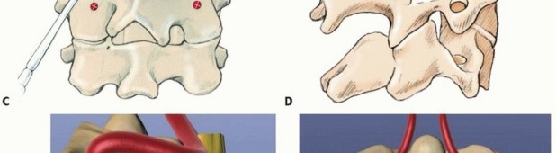Illustration 12 for Addressing Cervical Spine Instability with Posterior Arthrodesis