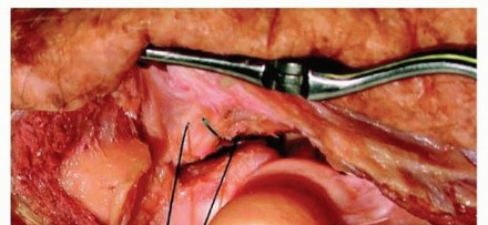 Illustration 18 for Restore Stability & Motion: Fixation of Fracture-Dislocations
