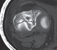 Illustration 59 for Optimal Nailing of the Tibia: Techniques for Challenging Fractures