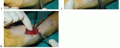 Illustration 32 for Mastering Midfoot Arthrodesis: Protect the Deep Neurovascular Bundle