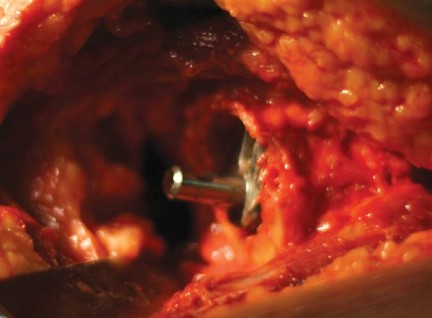 Illustration 24 for Considering METHA Short Stem? Discover Bone-Preserving THA