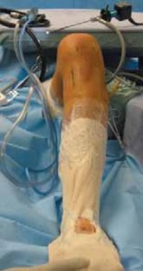 Illustration 6 for Cruciate Ligament Repair: Definitive Guide to Treatment & Recovery