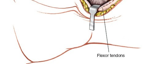 Illustration 187 for Essential Surgical Approaches: Uncover Every Aspect of the Wrist