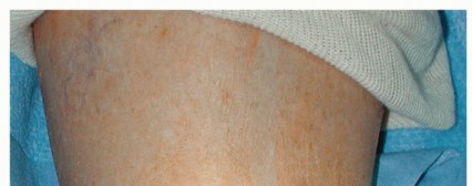 INBONE II: Optimize Stability with the Right Tibial Base Plate