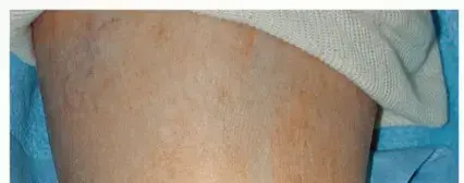 صورة توضيحية لـ استبدال مفصل الكاحل: دليل شامل لاستعادة الحركة والتخلص من الألم