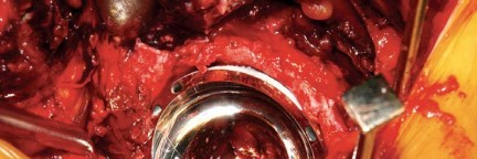 Illustration 66 for Birmingham Hip Resurfacing Designer's Technique for Active Lives