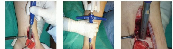 Illustration 26 for Painful Talus Lesions? The tech fig c Osteochondral Transfer Solution