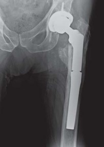 Illustration 33 for Effective Arthroplasty for Salvage of Failed Hip Fixation