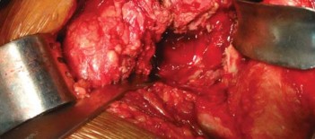 Illustration 15 for Optimizing Arthroplasty in Acute Fractures: Octopus System