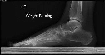 Foot Nodule Pain? Solutions for Masses along the Medial Cord