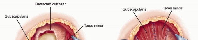 Illustration 27 for Subscapularis & Teres Rotator Cuff Repair: Advanced Techniques