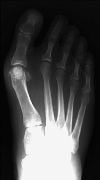 Medial Eminence Resection: Avoiding Hallux Varus & Recurrence