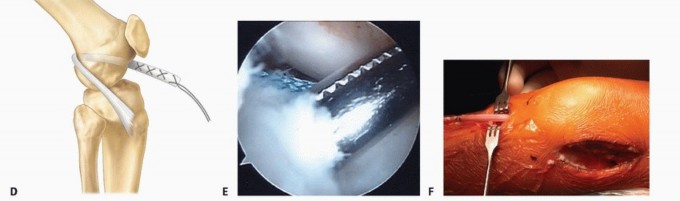Illustration 12 for Preventing Growth Plate Risk: ACL Reconstruction Using Autogenous Grafts
