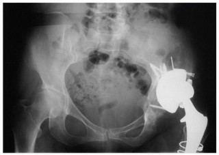 Illustration 2 for Uncemented Acetabular Revision: Optimizing Hemispherical Cup Use