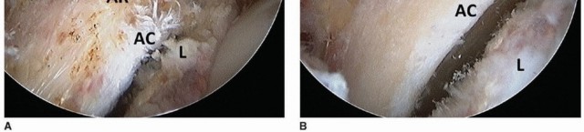 Illustration 25 for Beyond Knee Surg: Hip Arthroscopy for Sports Injuries