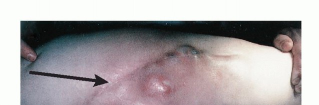 Anterior Flap Hemipelvectomy: Leveraging fig tech fig for Difficult Tumors