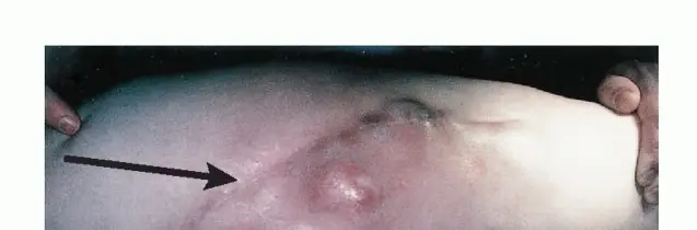 استئصال نصف الحوض بالرفرفة الأمامية: حلول متقدمة لأورام الحوض الصعبة مع الأستاذ الدكتور محمد هطيف في صنعاء