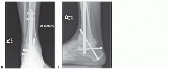 Illustration 41 for Unlock Stability: Medullary Nail Fixation for Tibiotalocalcaneal Arthrodesis