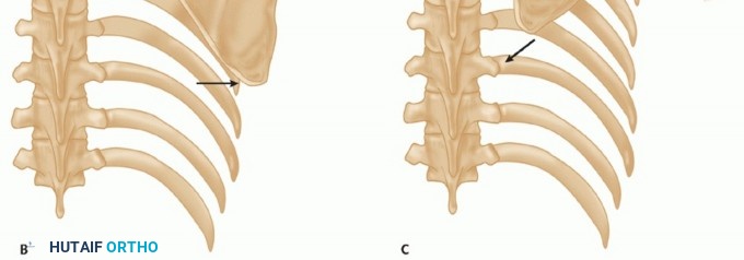 Illustration 5 for End CN XI Palsy Pain: The Eden-Lange Procedure Solution