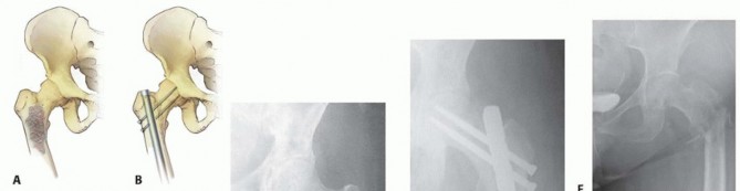 Illustration 11 for Regain Mobility: Total Hip Arthroplasty for Malignant Lesions