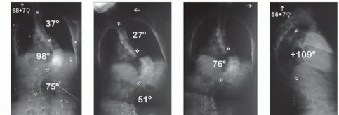 Illustration of vertebral column resection - Dr. Mohammed Hutaif