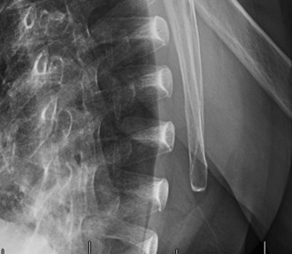Illustration 3 for Rotator Cuff Arthropathy: Decode the Diagnosis from a Case Study