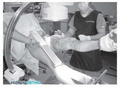 Illustration 7 for Achieve Optimal Femoral Head Fixation with Cephalomedullary Nailing