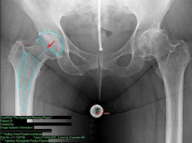 Illustration 13 for Unlock better THA: The technique of short stem for less invasiveness