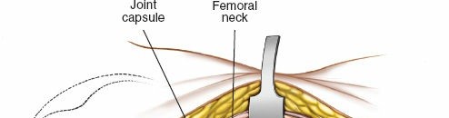 Illustration 22 for Acetabulum Posterior Approach: Simplest Fix for Hip Fractures